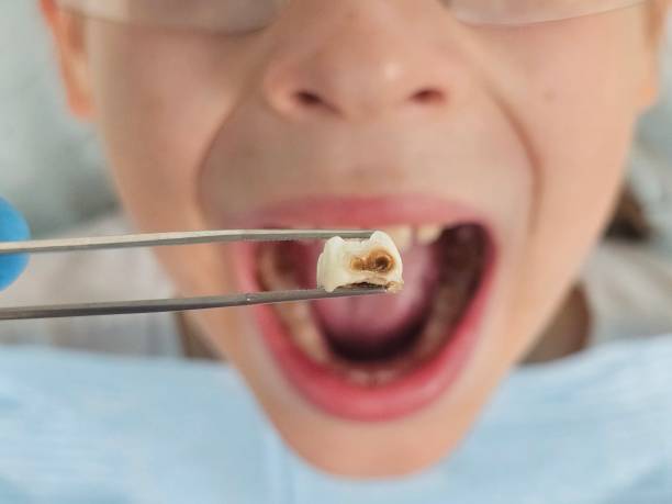 Best Knocked-Out Tooth (Avulsed Tooth) Treatment in Mount Olive, NC